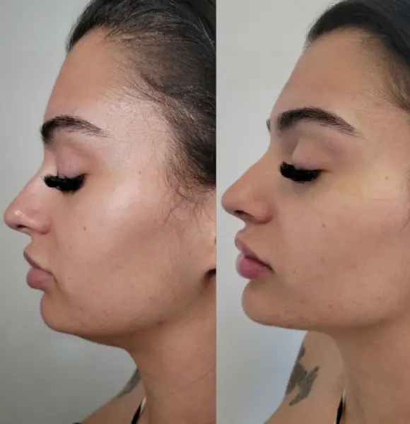 chin-filler-process