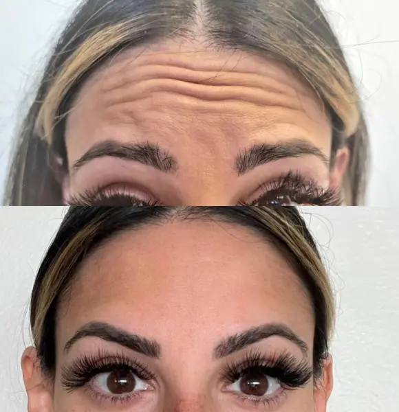 forehead-process