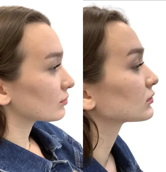 jawline-process