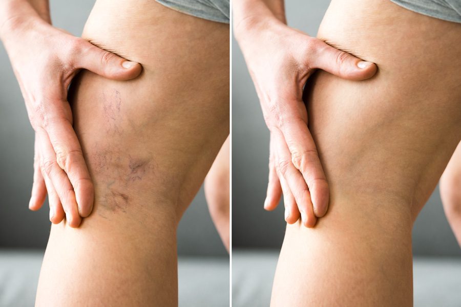 Sclerotherapy, SKIN medical aesthetics