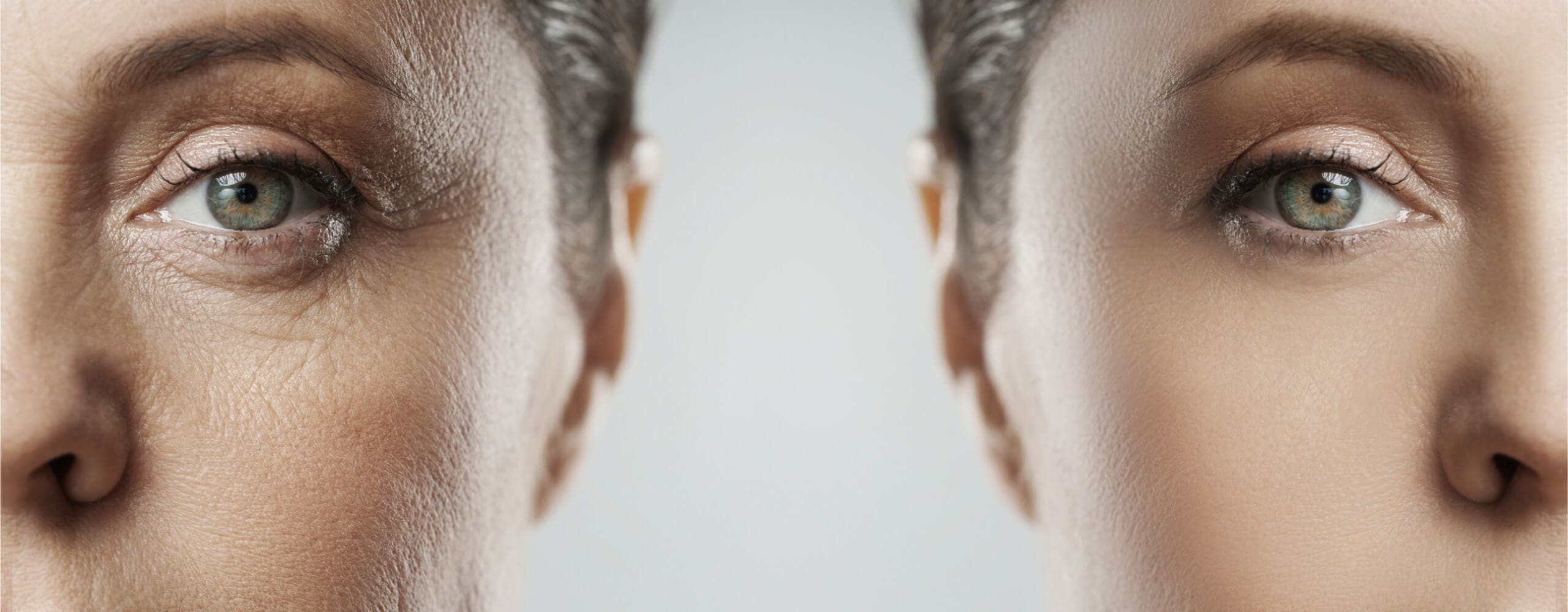 Preventative Botox: The Proactive Approach to Anti-Aging