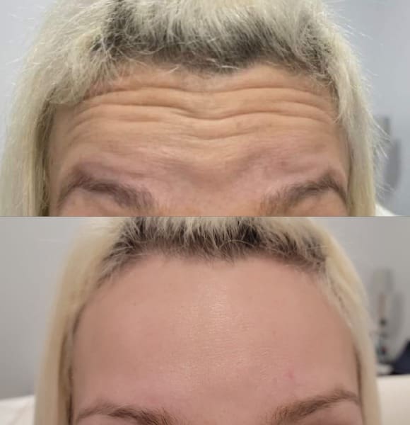 forehead-ideal