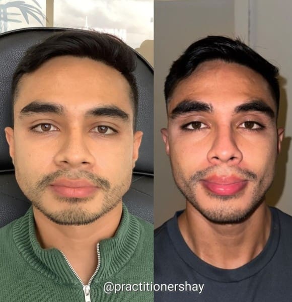 Masster botox before and after men