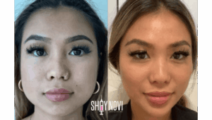 Facial-Balancing-vs-Traditional-Filler-Treatments