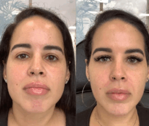 Before & After masseter botox