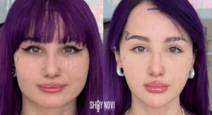 does-masseter-botox-help-with-tmj