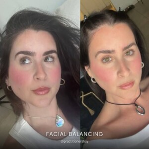 Facial balancing before and after women