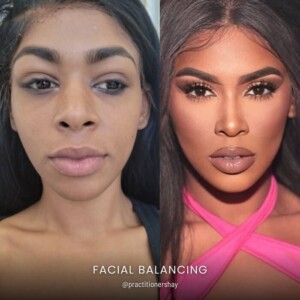 Facial balancing before and after women