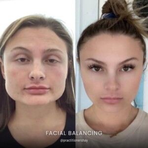 Facial balancing before and after women
