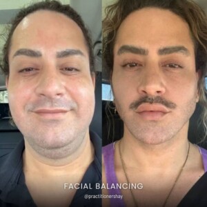 Facial balancing before and after men