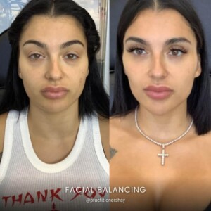 Facial balancing before and after women