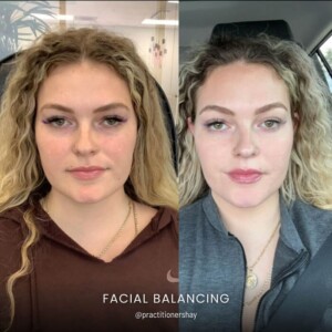 Facial balancing before and after women