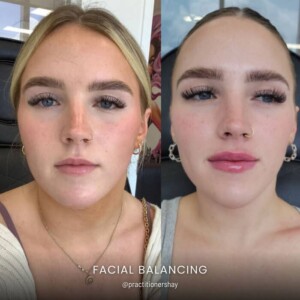 Facial balancing before and after women