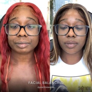 Facial balancing before and after women