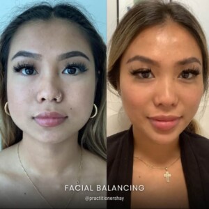 Facial balancing before and after women