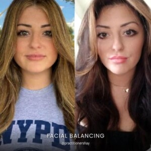 Facial balancing before and after women