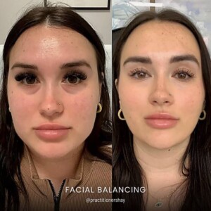 Facial balancing before and after women