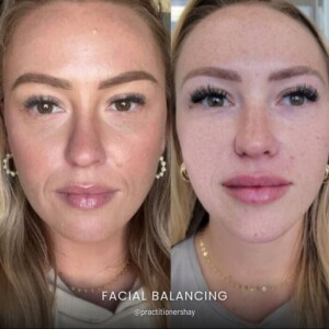Facial balancing before and after women