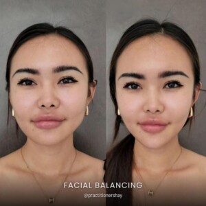 Facial balancing before and after women