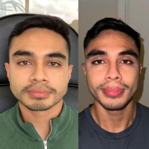 Facial balancing before and after men