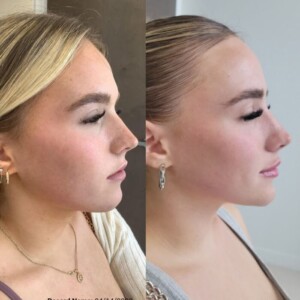 Facial balancing before and after women