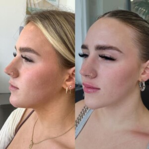 Facial balancing before and after women