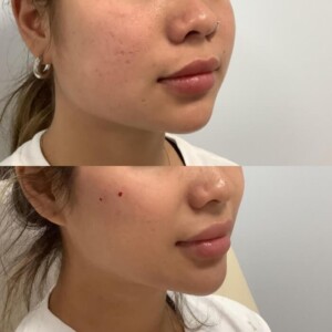 Facial balancing before and after women