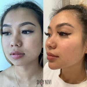 Facial balancing before and after women