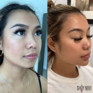 Facial balancing before and after women