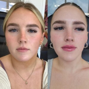 Facial balancing before and after women
