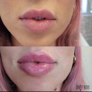 Natural lip enhancement with lip filler – before and after results