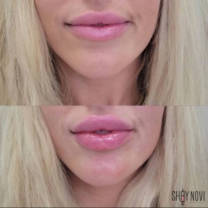 Before and after lip filler showing fuller, natural lips