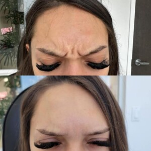 glabella-1