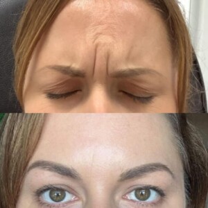 glabella-2