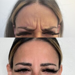glabella-3