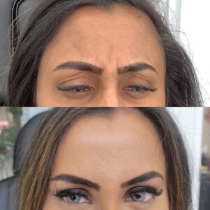 glabella-5