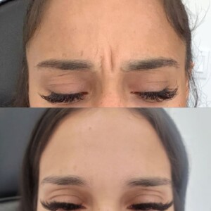 glabella-6