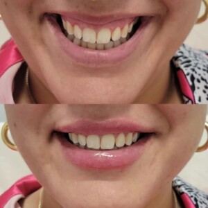 gummy-smile-1