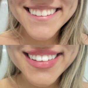 gummy-smile-5