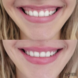 gummy-smile-6