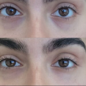 under eye filler before and after women
