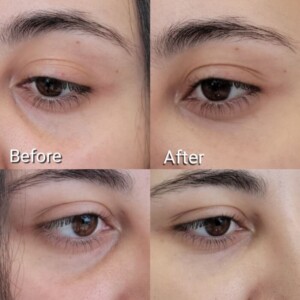 under eye filler before and after for female