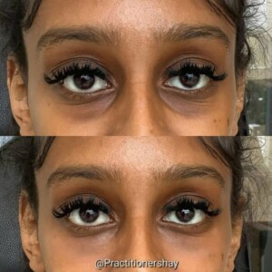 under eye filler before and after