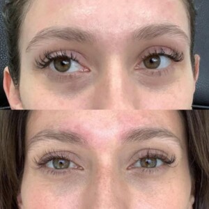 under eye filler before and after for women