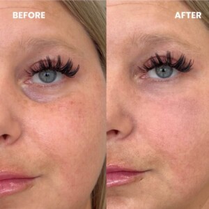 under eye filler before and after for women
