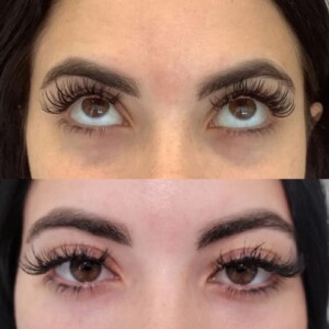 under eye filler before and after for women