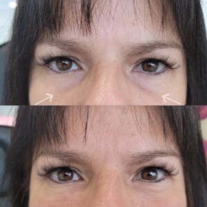under eye filler before and after for women