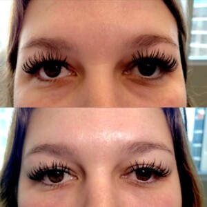 under eye filler before and after for women