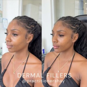 dermal before and after for female