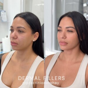dermal filler before and after female